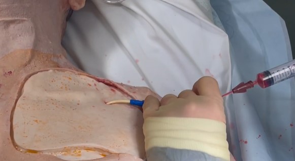 Subclavian line insertion